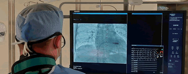 Lekarz przy monitorze podczas implantacji stymulatora bezelektrodowego Micra AV 2.0